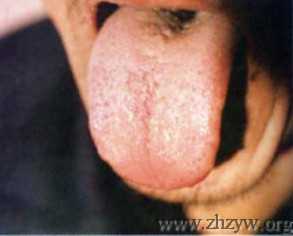 淡红舌白腻淡黄苔