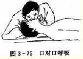 心肺复苏——口对口呼吸