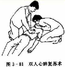 双人心肺复苏术
